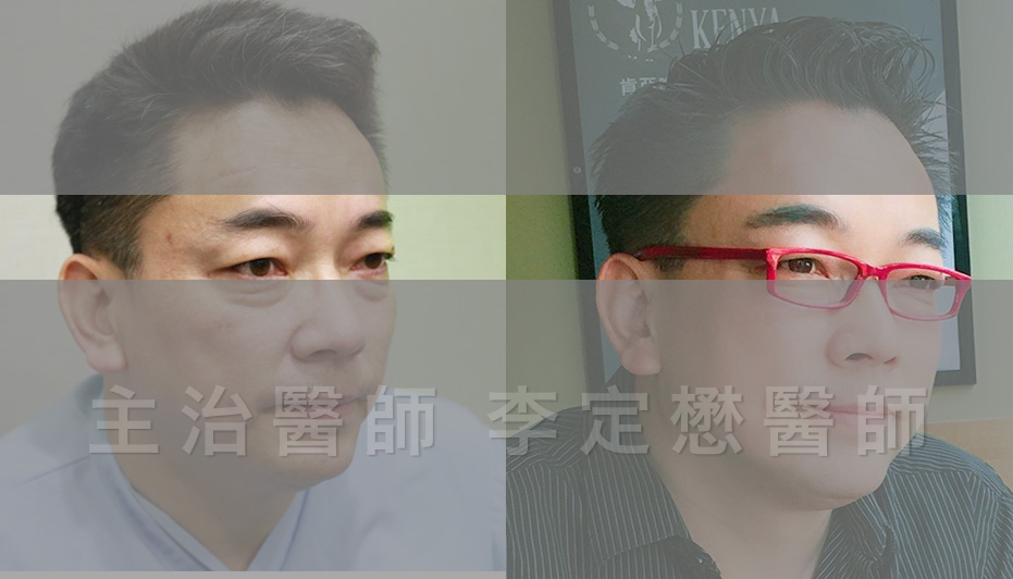 植髮,植眉,詹惟中,國光幫幫忙